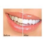 Hyper Dental Peeling Stick Teeth Care - صورة 2