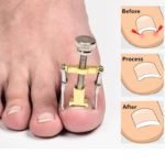Toenail Corrector - Image 5